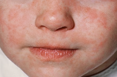 NEWS: The Measles Outbreak Has Hit Central Florida